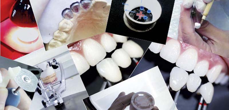 Implantes Dentales En Madrid